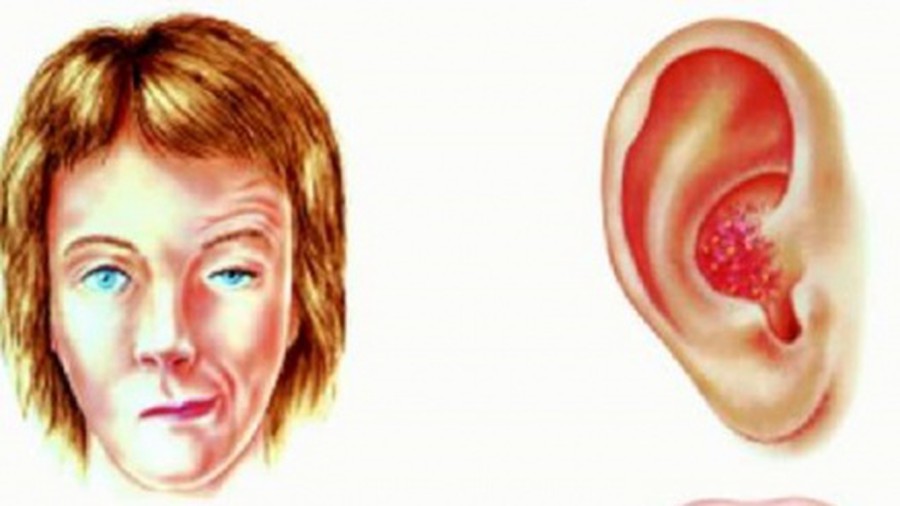 Zona hạch gối - Hình ảnh minh họa